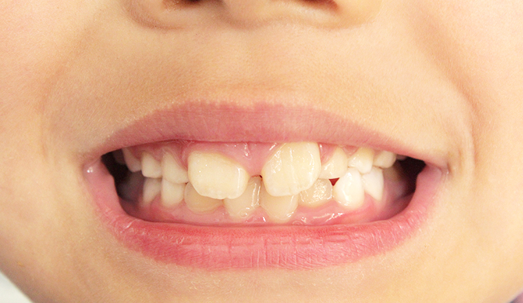 歯並び・噛み合わせの悪さが与える影響