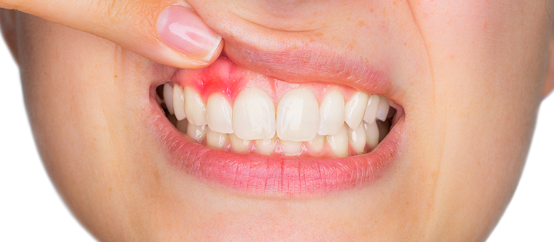 歯周病は歯を失う原因第1位です
