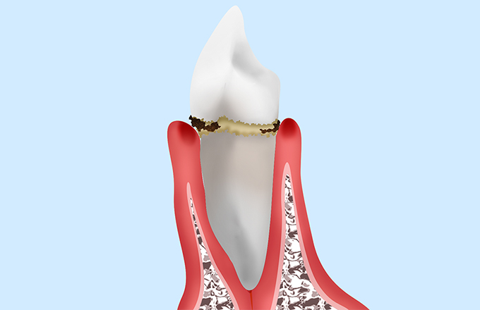 軽度歯周炎・歯肉炎