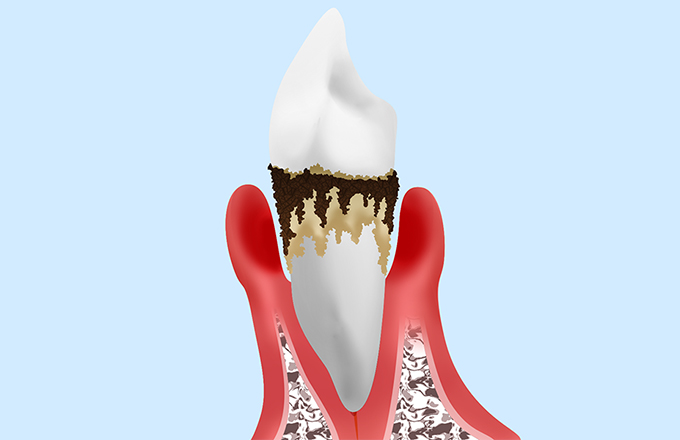 重度歯周炎